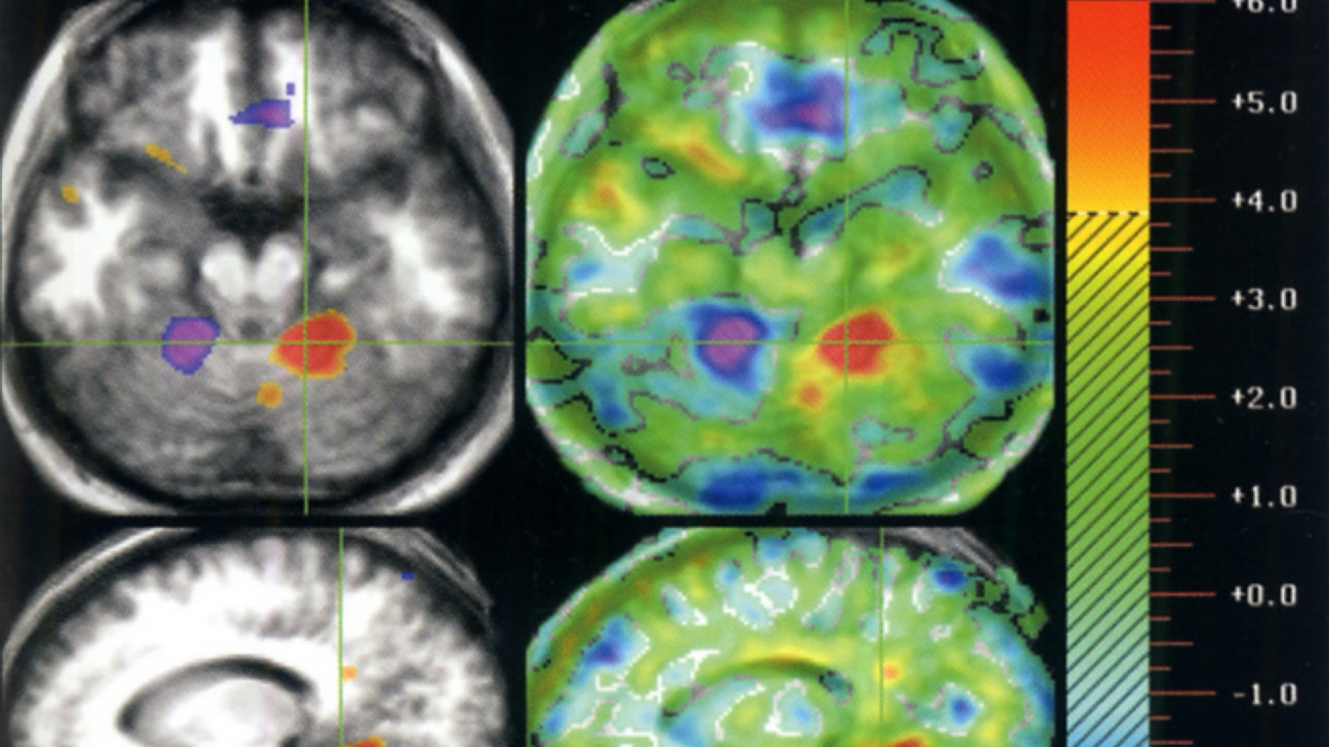Immagine di In stato vegetativo da 15 anni, recupera stato di minima coscienza
