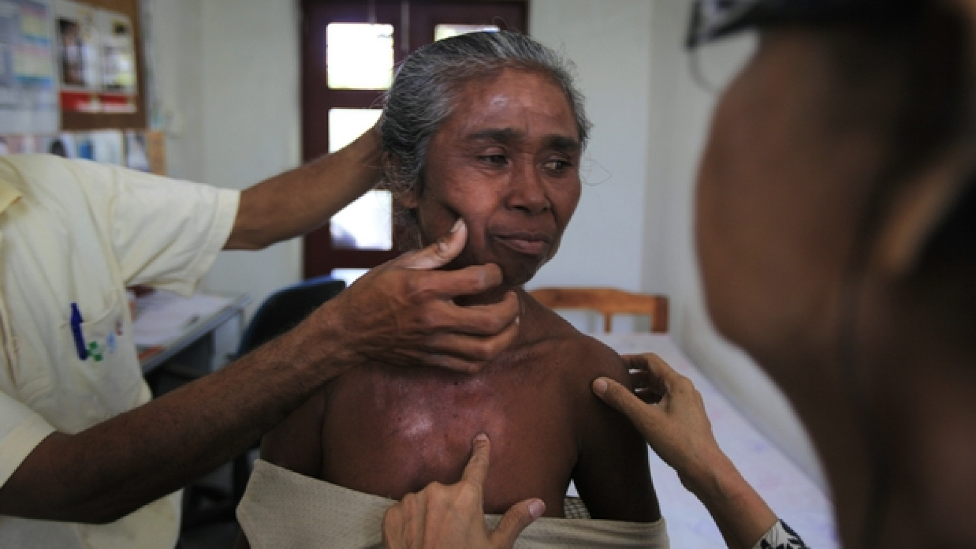 Immagine di Lebbra, è ancora l'India il Paese più colpito. Anche in Europa nuovi casi