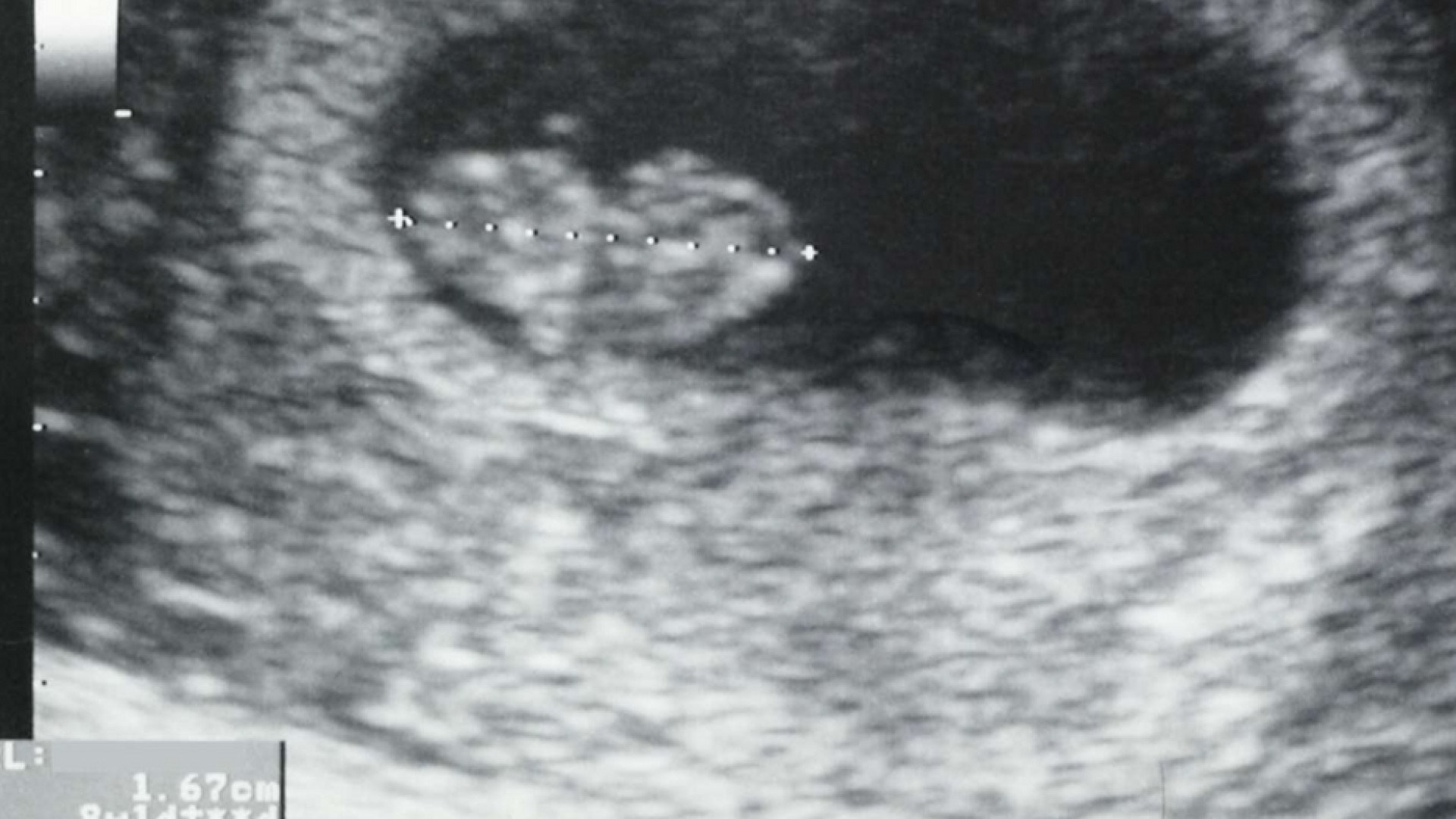 Immagine di Aborto, sul battito del feto una polemica elettorale