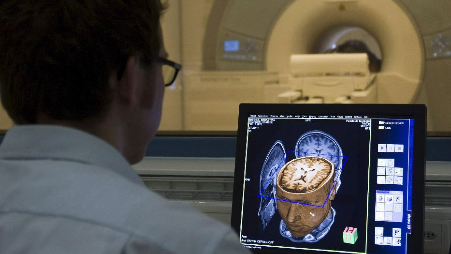 Immagine di Malato di Sla parla grazie a un lettore collocato nel cervello