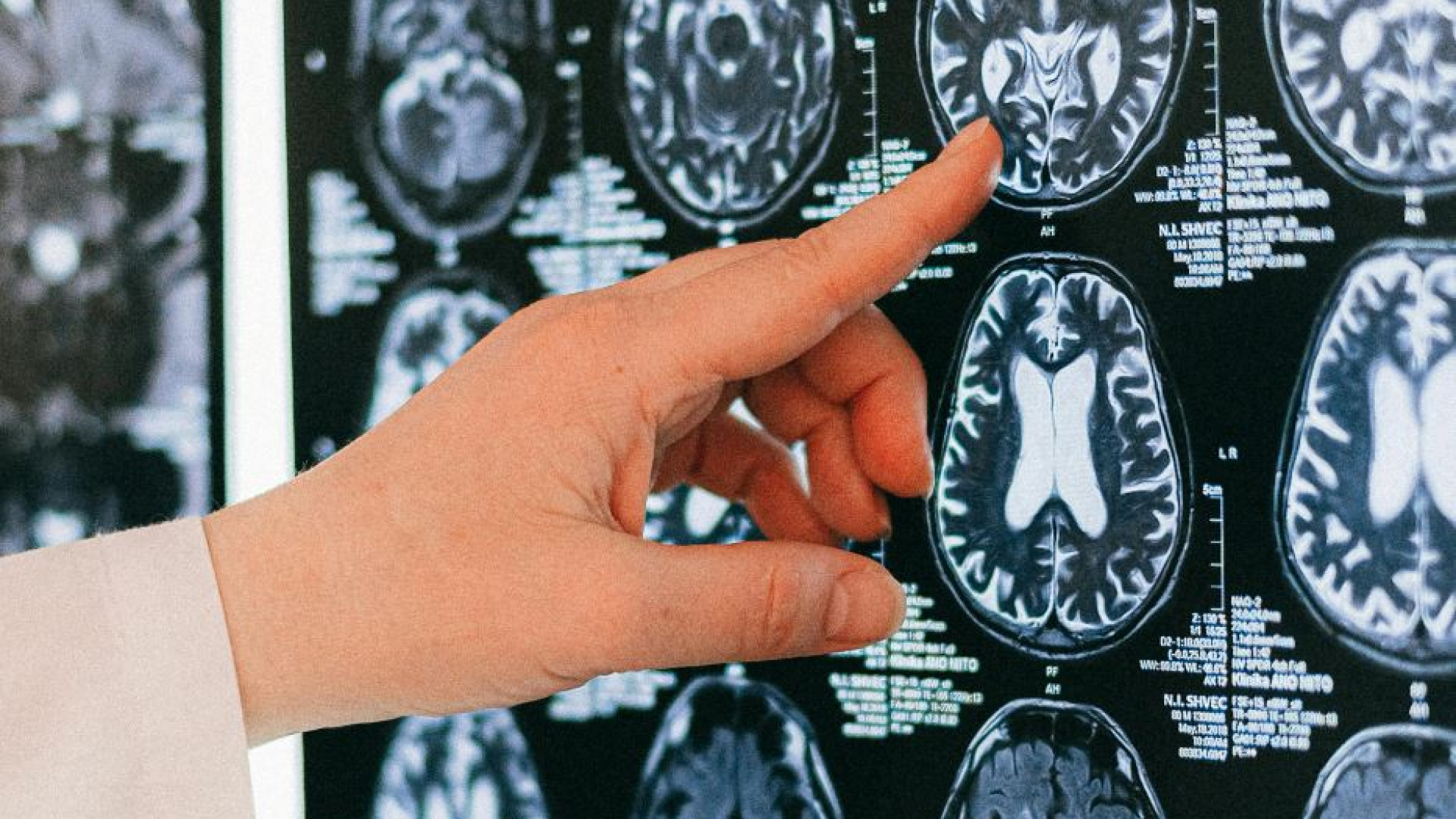 Immagine di Sintomi, prevenzione, terapie: cosa c’è da sapere sull’ictus