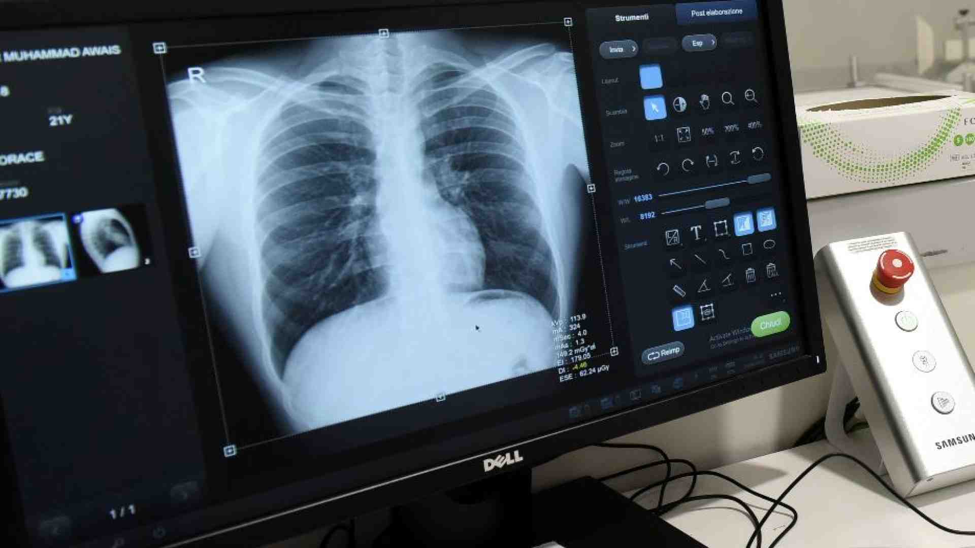 Immagine di Nuove cure per i tumori al polmone: rischio di morte ridotta dell'84%