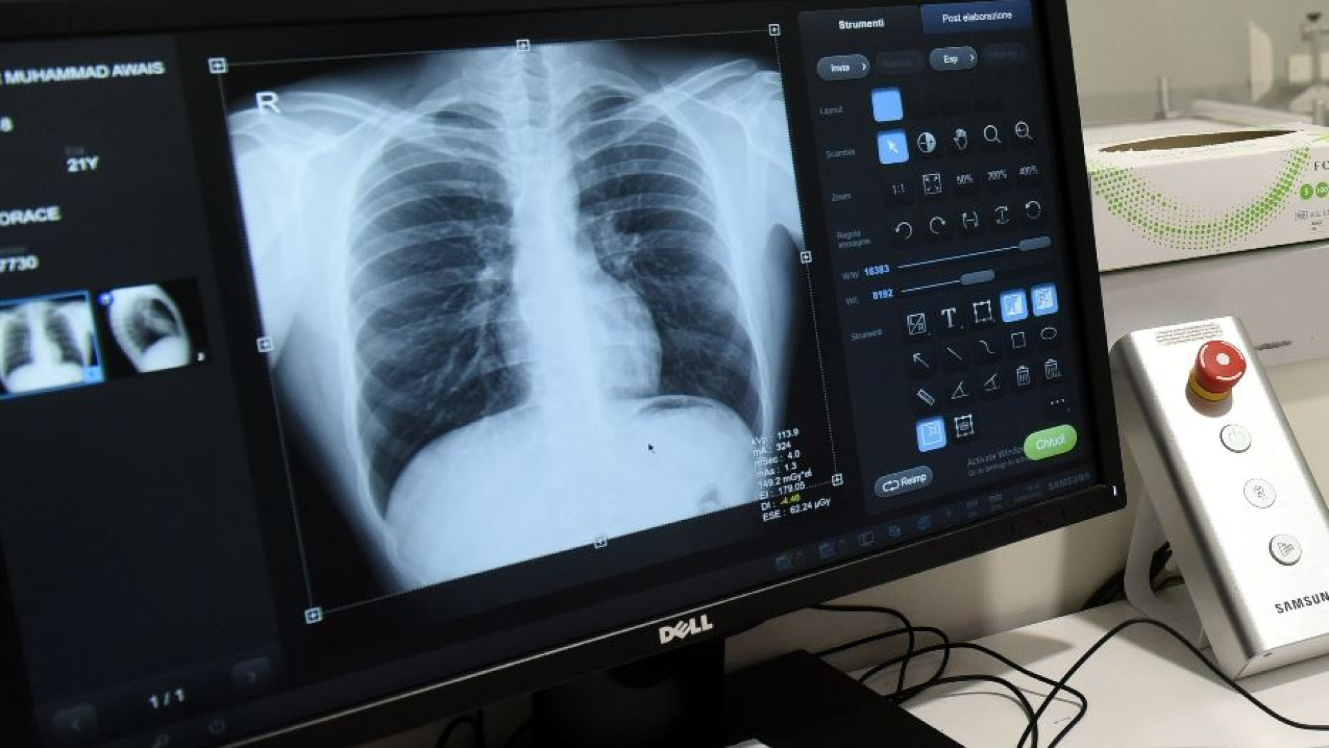 Immagine di Nuove cure per i tumori al polmone: rischio di morte ridotta dell'84%