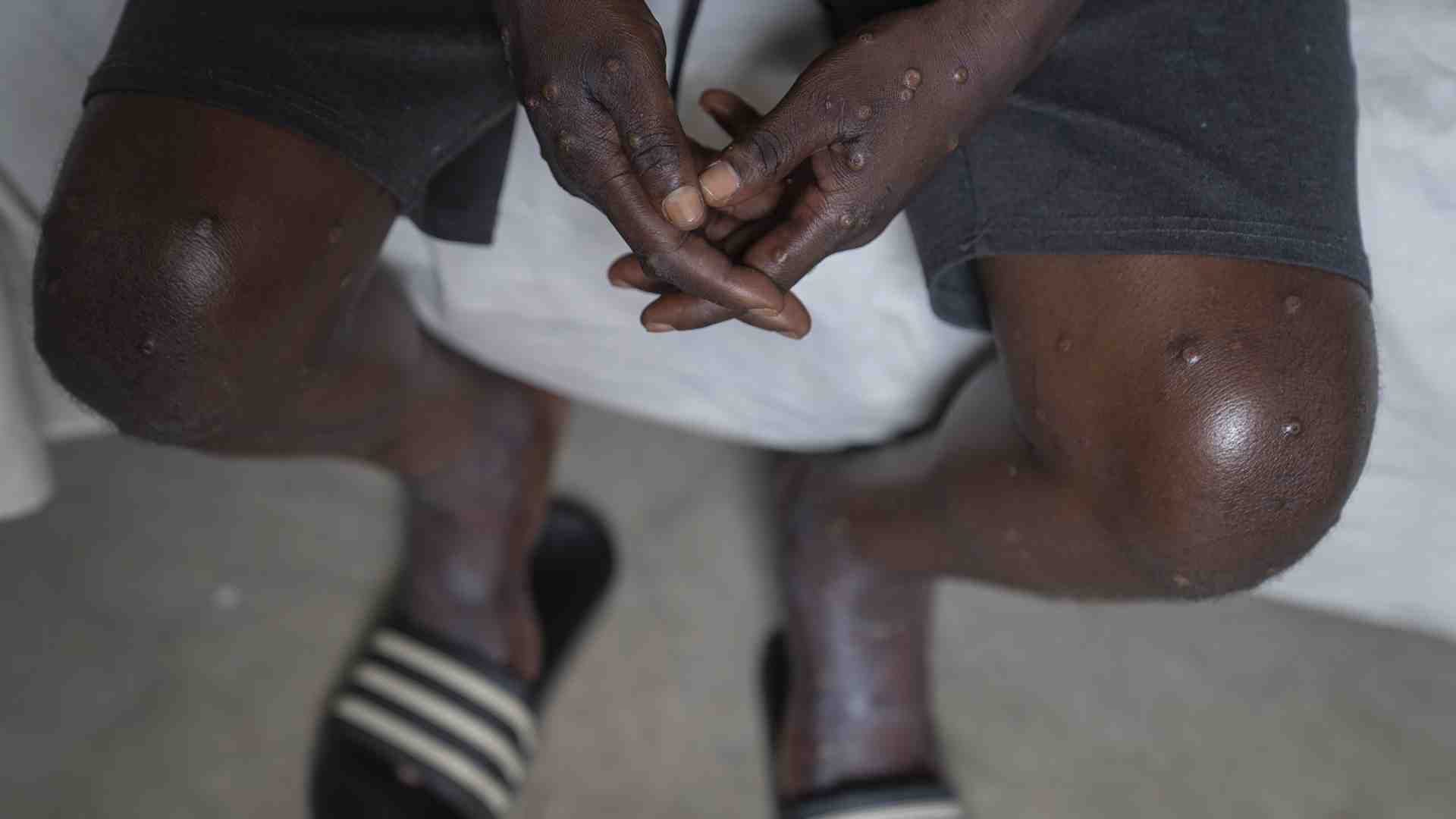 Immagine di Mpox: come si diffonde il vaiolo delle scimmie e cosa c'è da sapere