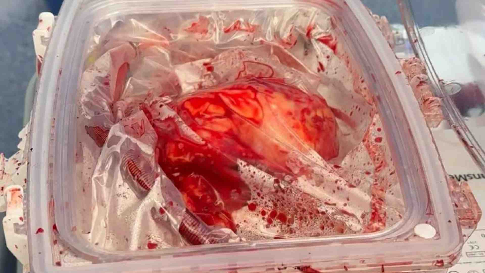 Immagine di È stato trapiantato un cuore sempre battente, dal prelievo all'impianto