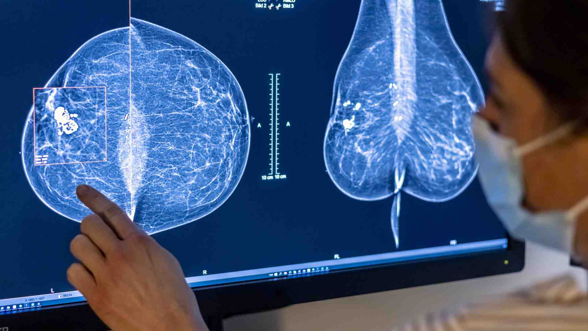 Immagine di Dottor IA: come migliorare la diagnosi di cancro al seno con l'intelligenza artificiale