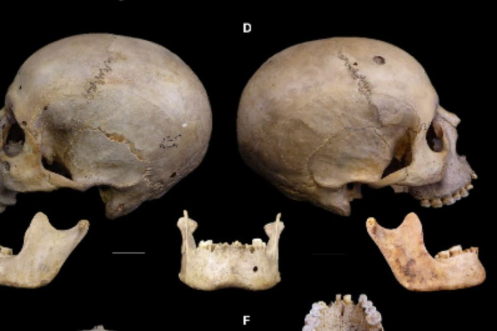 Il cranio operato di cancro nell'antico Egitto - Tondini/Isidro/Camaros