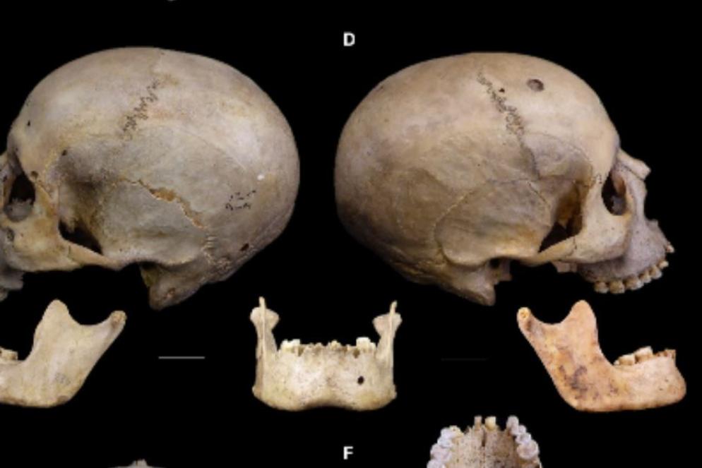 Il cranio operato di cancro nell'antico Egitto - Tondini/Isidro/Camaros
