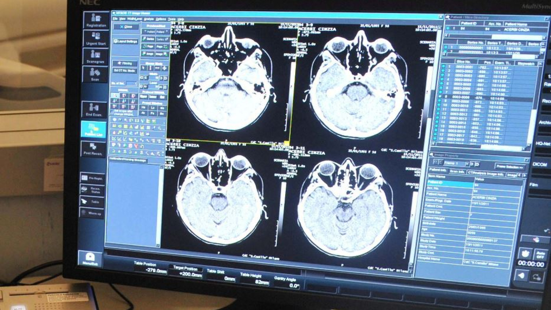 Immagine di Il peso dell'ictus, importanti prevenzione e cure precoci