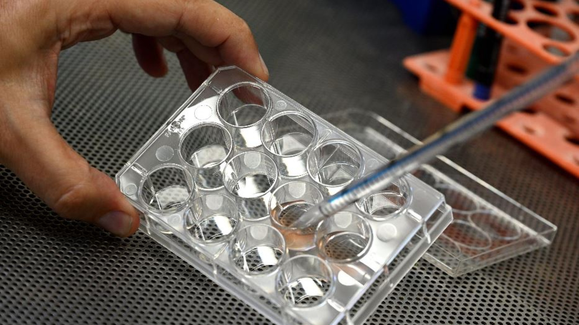 Immagine di Sclerosi multipla, «risultati positivi» da trapianto di staminali nel cervello
